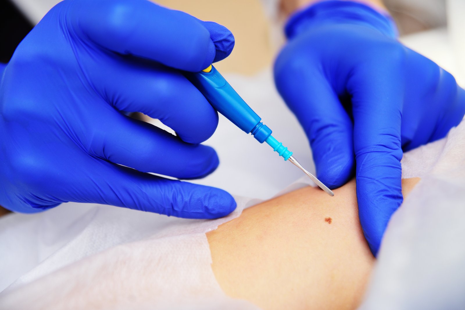 Dermatoscope examination