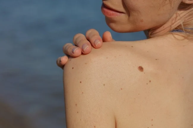 Dermatoscope examination