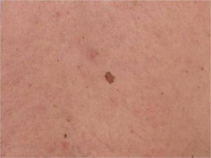 Early Melanoma