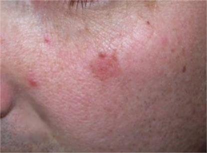Actinic Keratosis